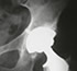 orthopedic implants en guadalajara