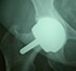 Orthopedic knee prostheses guadalajara