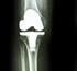 Orthopedic hip prostheses guadalajara