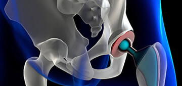 Orthopedic hip prostheses