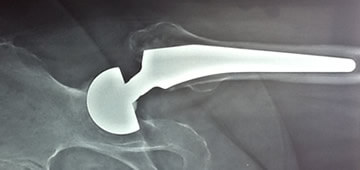 orthopedic implants