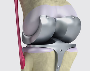 Orthopedic prostheses Guadalajara