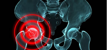 Orthopedics and hip replacement guadalajara